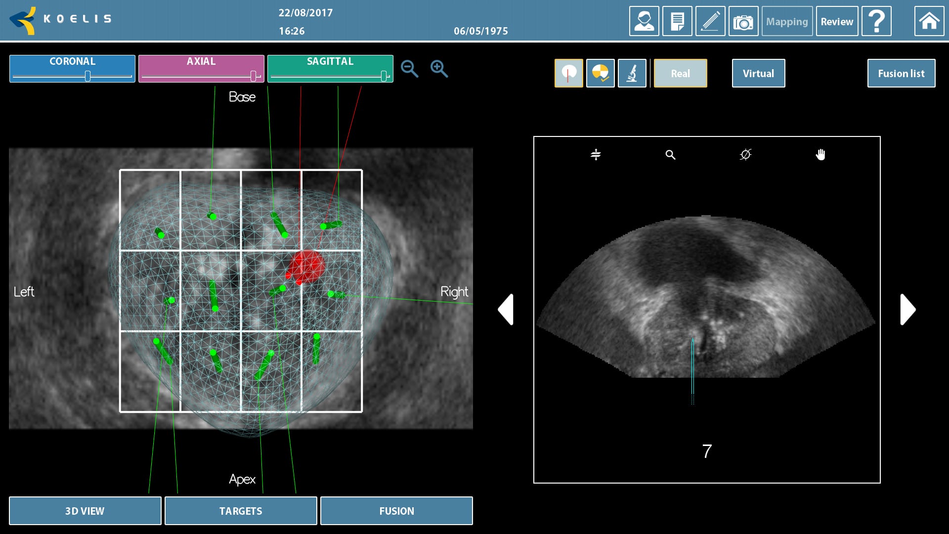 Biòpsia de pròstata convencional i mitjançant fusió amb programari